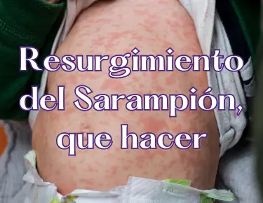 Resurgimineto del sarampion que hacer foto del abdomen de un bebé con sarampión